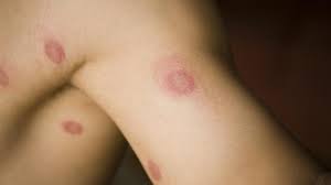 This has really prolonged the healing process for him. What Does Skin Cancer Look Like
