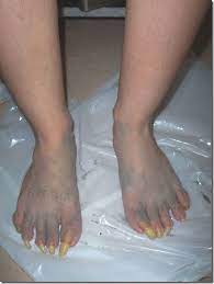 Pies feos uñas acrílicas en pies uñas de gel para pies dedos del pie de gel diseños para uñas del pie diseños de uñas de acrílico memes de remedio casero para el hongo en las uñas (9 opciones naturales). Fotos De Las Unas Mas Largas Del Mundo De Pies Y Manos El Blog De Humor