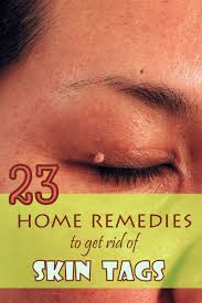 Home Remedy Hacks Skin Tags Home Remedies Skin Tag Removal Health And Beauty Tips