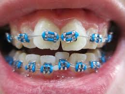 Braces Colors Black And Blue Blue Braces Colours Teeth Braces Ideas Braces Colors Teeth Braces Orthodontics Braces