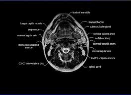10 rectus abdominus muscle this muscle is consider. Mri Neck Anatomy Free Mri Axial Neck Cross Sectional Anatomy