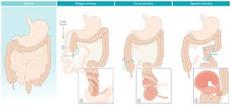 Volvulus And Intestinal Malrotation Amboss