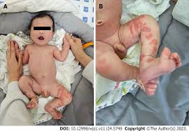 Image result for Erythema Multiforme Causes