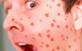 Hal ini bisa ditandai dengan badan yang terasa panas namun bukan demam. Kenali Dan Cegah Virus Penyebab Cacar Air K Link Indonesia