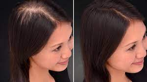 My surgeon has suggested using hair fibers after my hair transplant to thicken the results. How Toppik Works On Hazel S Genetic Hair Loss Toppik Blog