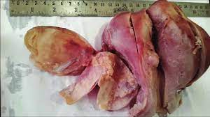 How to use open up in a sentence. Gross Specimen Of Cut Open Uterus With Multiple Fibroids And Opened Up Download Scientific Diagram