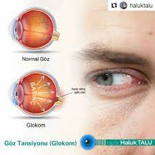 Repost Haluktalu Get Repost Goz Tansiyonu Tibbi Adiyla Glokom Genellikle Goz Ici Basincin Yukselmesi Nedeniyle Gorme Sinirinin Zarar Gormesi Durumudur En Sik Sebebi Genetik Faktorler Olup Goz Ici Enflamasyonlar Travmalar Kortizon Kullanimi