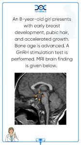 Image result for GnRH Stimulation Test