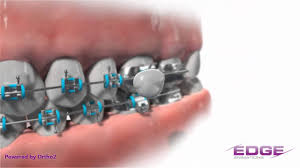 How to use orthodontic wax for braces. How Do I Use That Braces Wax Salem Pediatric Dental