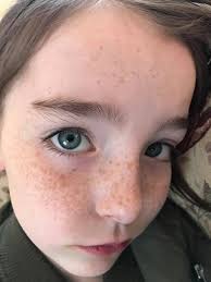 Beauty of facial moles and freckles