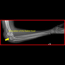 Image result for Radial Head Dislocation