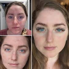 Halvvägs (4 månader) och äntligen lever jag ett liv med självförtroende  utan smink och blir av med envis melasma efter graviditeten! : r/Accutane