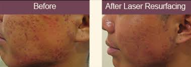 Pin On Lasers And Skin Rejuvenation