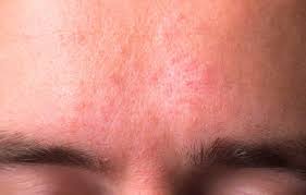 L'idrocortisone crema è il corticosteroide più sicuro per il volto, poiché i corticosteroidi fluorinati possono causare effetti avversi (p. Dermatite Seborroica 4 Rimedi Naturali Per Viso E Capelli