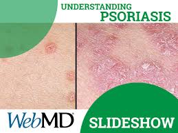 Psoriasis Pictures A Visual Guide To Psoriasis On Skin Nails And More Dry Skin Causes Psoriasis Dry Skin Patches