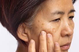 Image result for Melasma