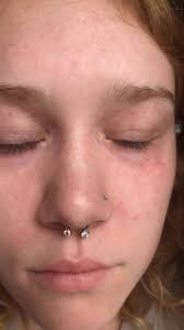 Hey guys cant seem to figure this one out. The past month or 2 ive been  getting spots all over my face that are slightly raised and red/purple. It  only happens every once in awhile but they in person ...