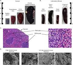 Image result for Splenomegaly