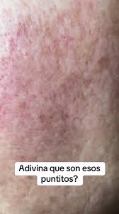 Image result for demodex rosacea