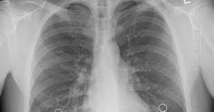 There are many possible causes of . Egfr Gene Found In Mesothelioma Silences Tumor Suppression