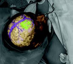 In preparation for delivering the 10th annual olga m. Brain Surgery Not Rocket Science The Bmj