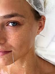 Becoming an acupuncturist requires intensive higher education and practical experience. How To Become An Acupuncturist In Alberta Arxiusarquitectura