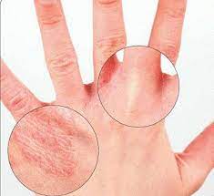 G e o r g i f. Pellagra Ist Die Ursache Und Symptome Von Pellagra