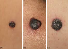 Look at your skin from head to toe; Diagnosis Of Primary Melanoma Sciencedirect