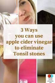 Pin On Tonsil Stones Remedies