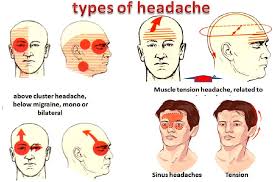 Image result for Acute Localized Headache