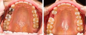Smoking After Wisdom Teeth Removal With Stitches Teethwalls