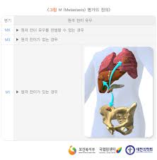 췌장암 4기 환자가 면역치료를 받으면 생기는 일 2부_샘병원 치료사례(췌장암 및 췌장암의 간, 복막 전이) 췌장암 4기 환자가 면역치료를 받으면 생기는 일 1부_샘병원 치료사례(췌장암 및 췌장암의 간. Uniquitous ìžìœ ê²Œì‹œíŒ Free Bulletin Board