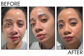 The 10 Best Concealers for Acne of 2025