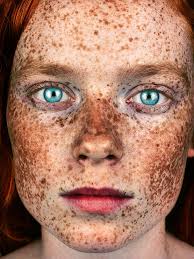 Image result for Freckled skin