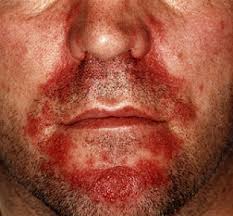 Image result for Seborrheic Dermatitis