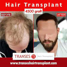 Before After 4500 Graft Hair Transplant Whatsapp 905334704247 905464434247 905464884047 905464024 Hair Transplant Hair Transplant Price Beard Transplant