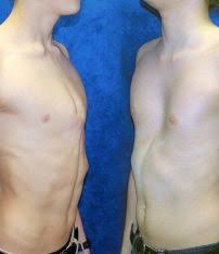 Pectus excavatum and carinatum support, photos, community, forum. 9 Pectus Excavatum Ideas Pectus Excavatum This Or That Questions Marfan Syndrome