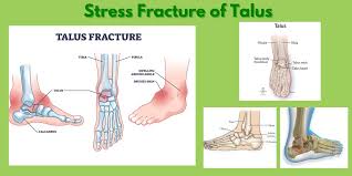Image result for Talus Fracture