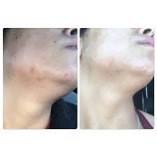 It can usually be used along with other products, including those intended to treat acne, such as benzoyl peroxideand salicylic acid. B A 2 Weeks Of Azelaic Acid In The Am And Yesto Correct And Repair Night Mask I M Happy With Only These Two Weeks Worth Of Progress And Can T Wait To Post A