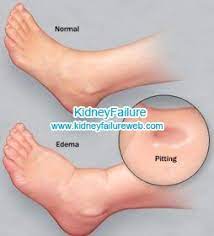 Setiap buah pinggang mengandungi lebih sejuta struktur berbentuk bola kecil dinamakan glomeruli. Penapis Buah Pinggang Bocor Nephrotic Syndrome