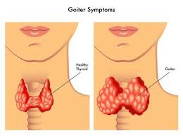 Goiters Abnormally Large Thyroid Glands Throat Cancer Thyroid Treatment Thyroid Disorders