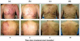 Male breast cancer can exhibit the same symptoms as breast cancer in women, including a lump. Figure 1 A Case Of Her2 Positive Male Breast Cancer With Lung Metastases Showing A Good Response To Trastuzumab And Paclitaxel Treatment Springerlink