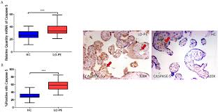 Placentas from Women with Late-Onset Preeclampsia Exhibit Increased  Expression of the NLRP3 Inflammasome Machinery
