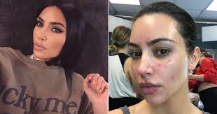 29,527,163 likes · 1,067,126 talking about this. Kim Kardashian Talks About Her Psoriasis With Photos Popsugar Beauty