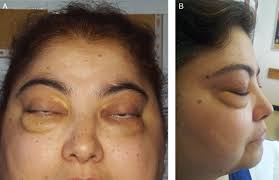 Image result for Dacryoadenitis