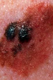It may become hard or lumpy. Stage 4 Melanoma Survival Rate Pictures And Treatment