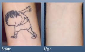 This skin tag remover from the united states was reportedly proven to work in clinical trials. Laser Tattoo Removal In Lehigh Valley Allentown Easton