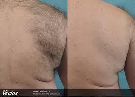 I did 2 laser sessions and deeply regret the procedure as the beard hair on my neck grows patchy now. Hinsdale Laser Hair Removal For Men Laser Aesthetic Center