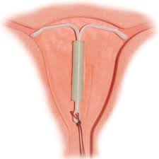 Progestin thins your uterine lining, thickens cervical mucus so it's harder for sperm to swim through, and partially suppresses ovulation so. Mirena Iud Lawsuits Information About Mirena Iud Injury Problems