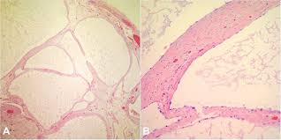This study tested the hypothesis that immunocytochemistry (ic) in effusion cell blocks (cb) can distinguish mm from rm and that the results may be applied to individual specimens. Benign Multicystic Peritoneal Mesothelioma Literature Review And Update
